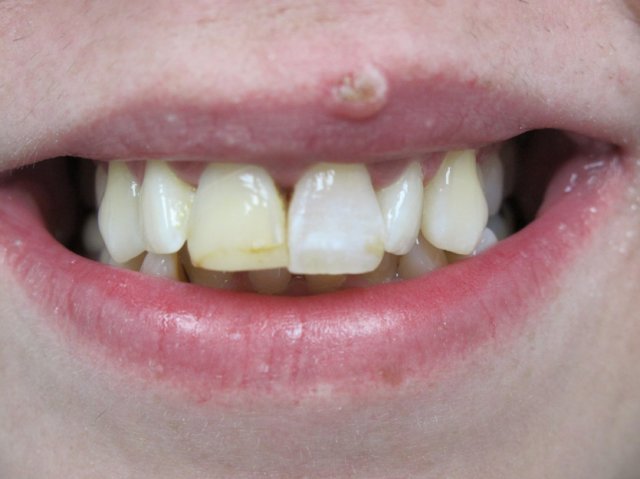 Internal Bleaching After